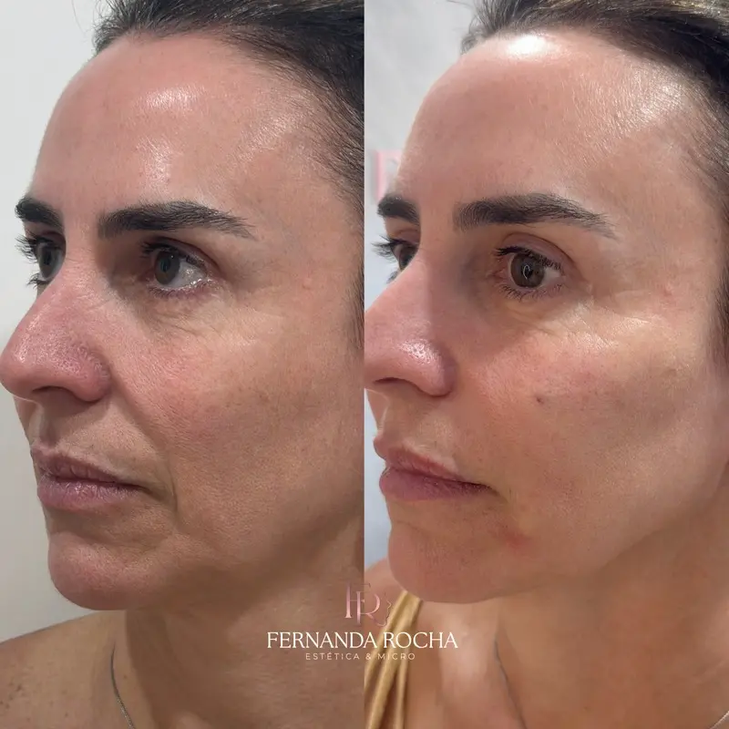Procedimento por Fernanda Rocha